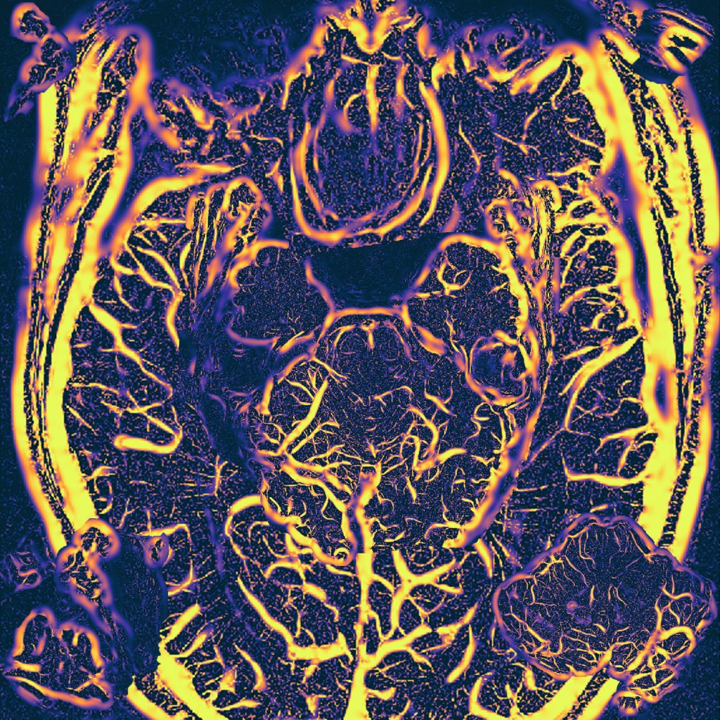 Susceptibility weighted images produce amazing visualization of the vessels. A Frangi filter was used to emphasis the  vessels, and elements of the brain were hidden within.
