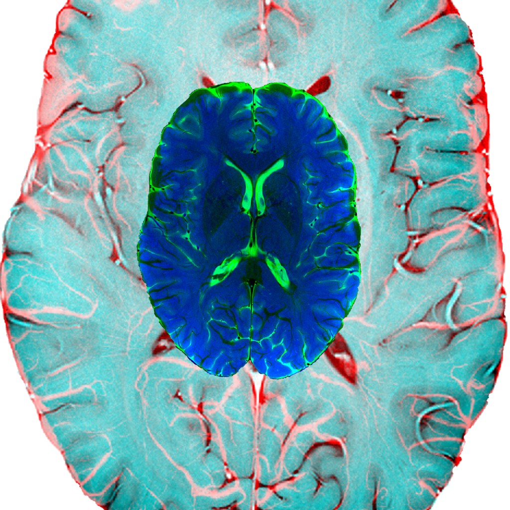 an SWI image overlaid on a T2TSE image